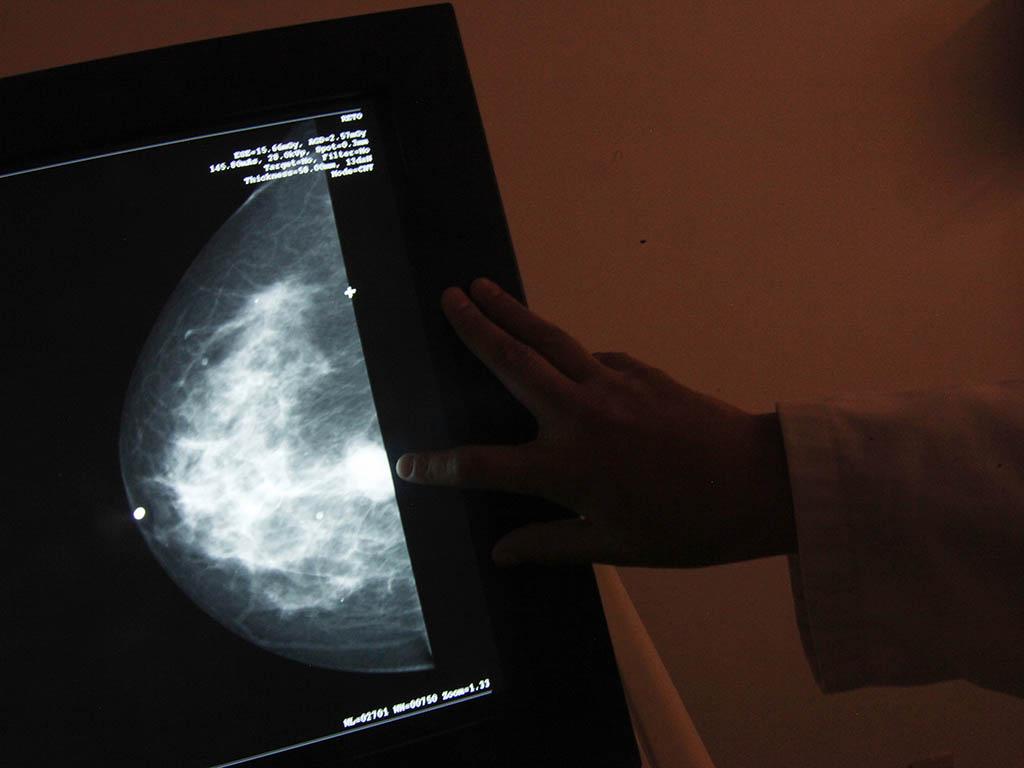 Mamografia (Reuters)