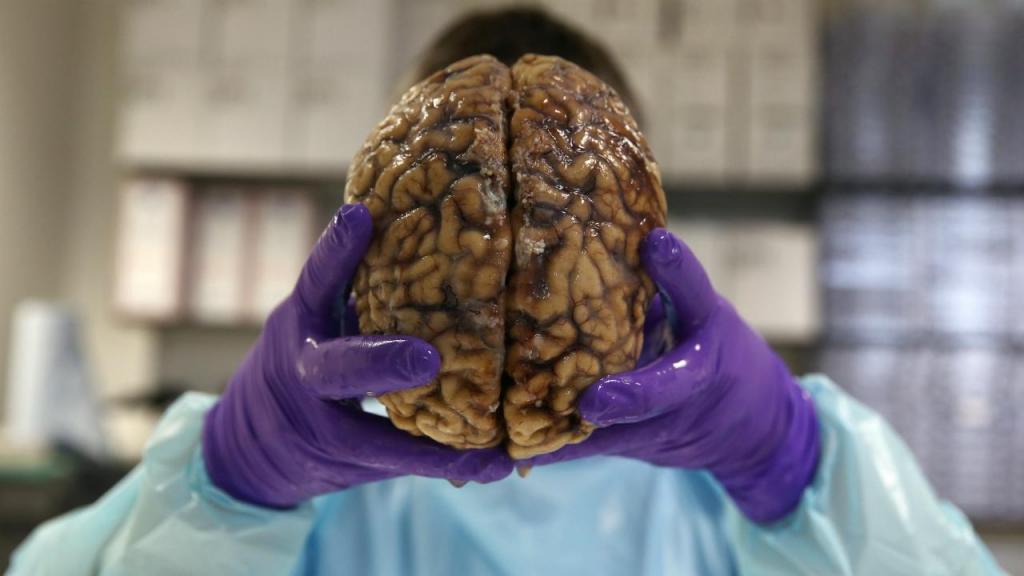 Morte de neurónios pode ajudar doentes de Alzheimer | TVI24