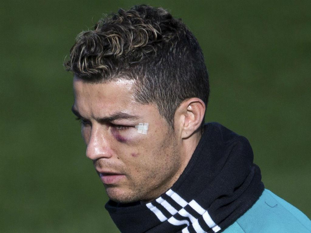 Ronaldo com o olho negro no treino (EPA/Rodrigo Jimenez)