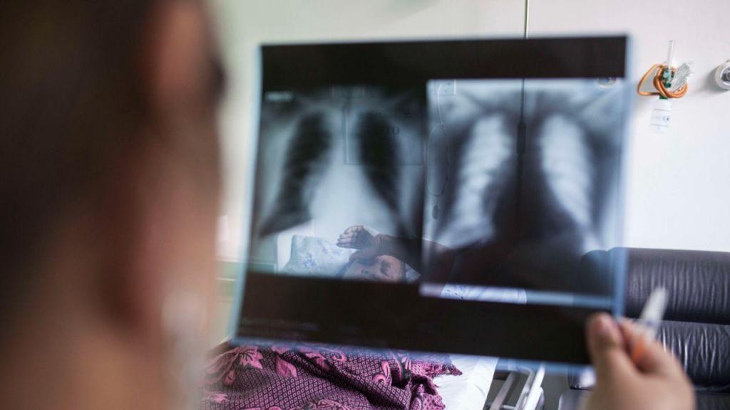 Raio-X aos pulmões (Getty Images)