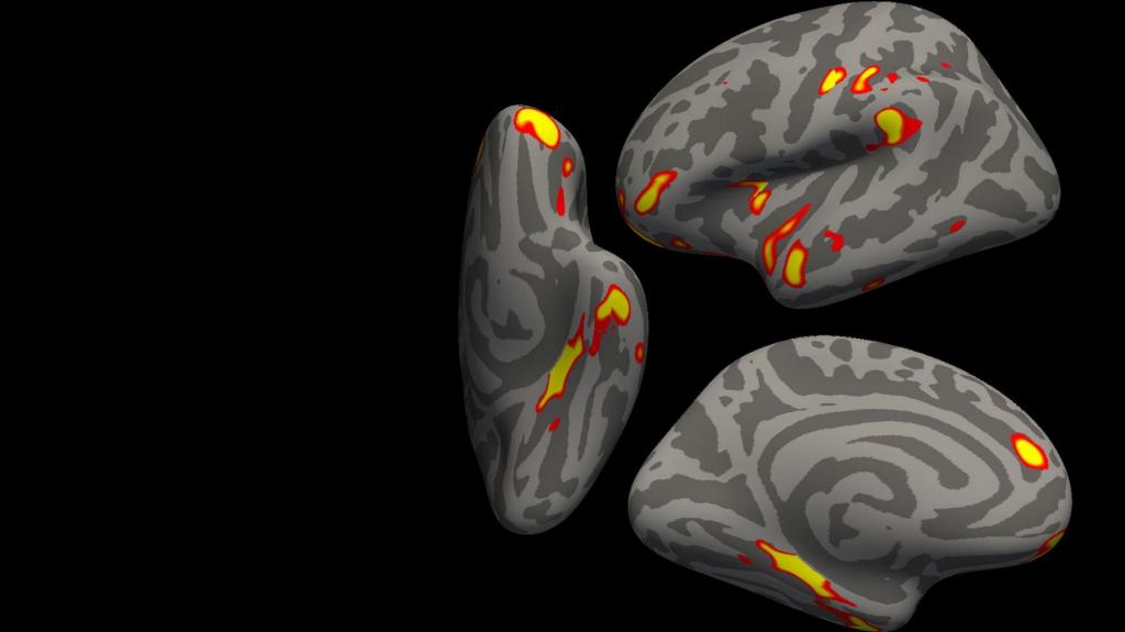 As regiões amarelas e vermelhas são partes do cérebro que encolheram mais nos participantes infetados deste estudo quando compados com os participantes não infetados. Imagem: G. Douaud, em colaboração com Anderson Winkler e Saad Jbabdi, da Universidade de Oxford e do NIH.