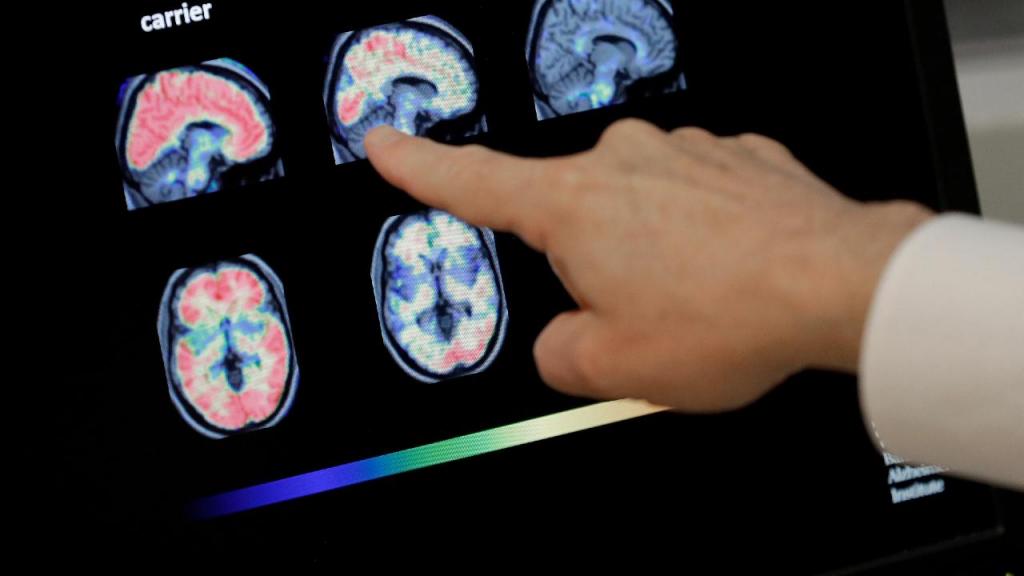 Imagem de uma Tomografia por Emissão de Positrões (TAC) cerebral. (AP Photo/Matt York, File)