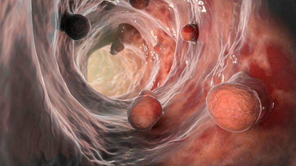 Cancro do colo-retal (Getty Images)