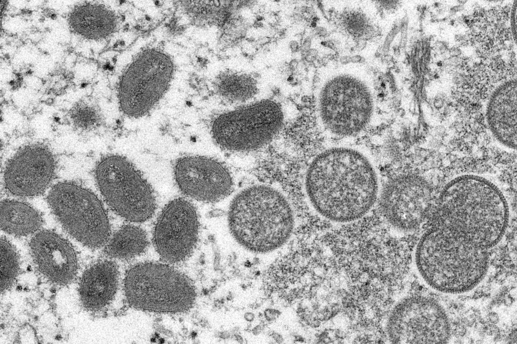 Monkeypox (Cynthia S. Goldsmith, Russell Regner/CDC/AP)