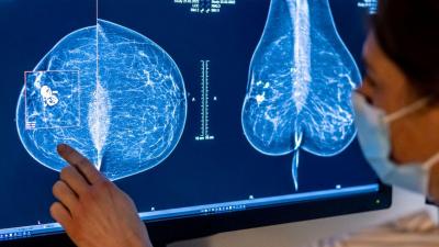 Inteligência Artificial foi tão eficaz quanto dois radiologistas a analisar mamografias, revela estudo - TVI