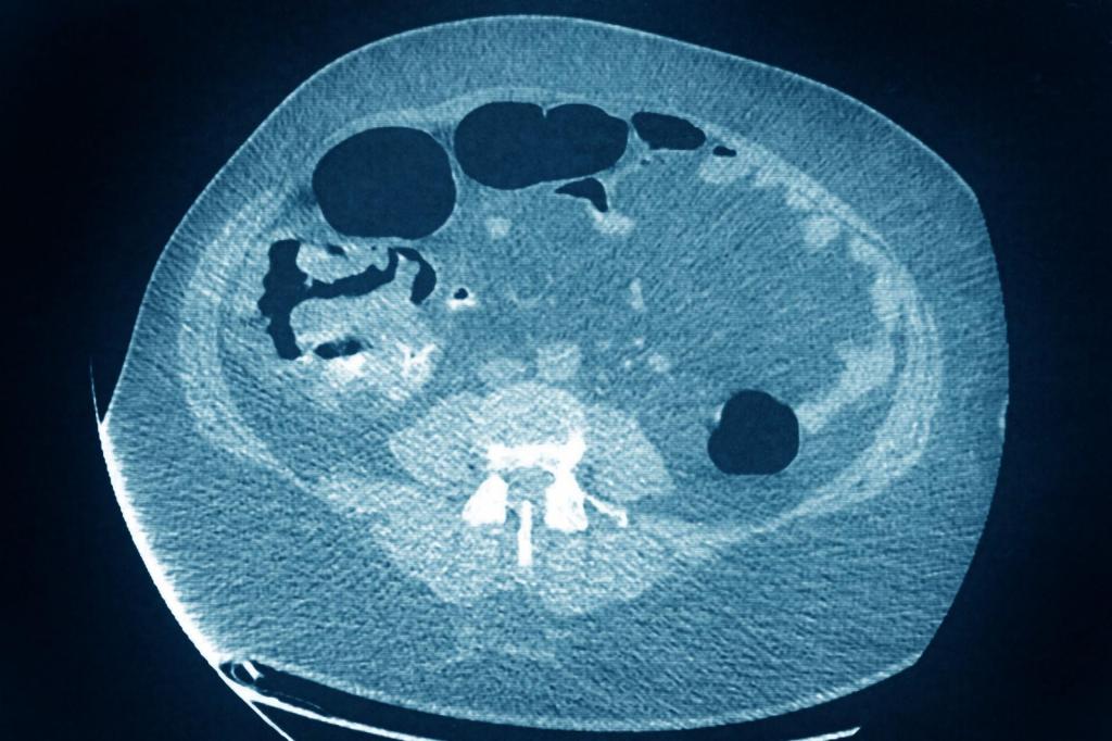 Cancro do cólon (Foto: BSIP/Universal Images Group via Getty Images)