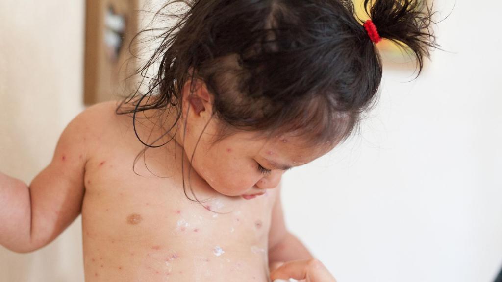 Criança com varicela (BSIP/Universal Images Group via Getty Images)