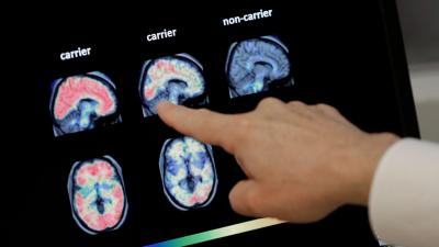 Ponto de viragem na luta contra o Alzheimer. Novo fármaco retarda declínio cognitivo em pouco mais de um ano - TVI