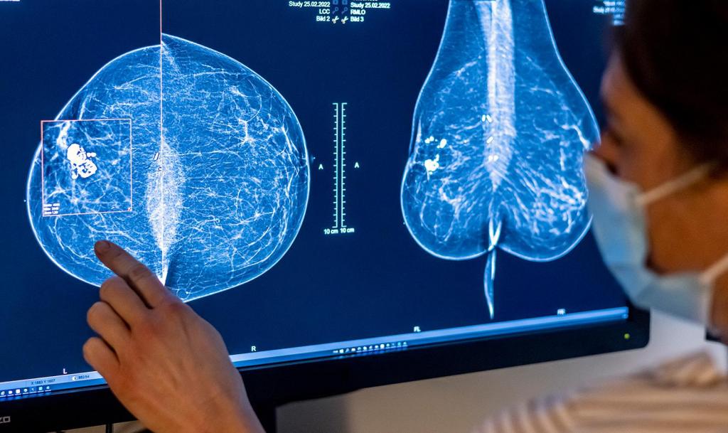 A densidade mamária pode ser medida com uma mamografia. Foto: Michael Hanschke/picture alliance/Getty Images